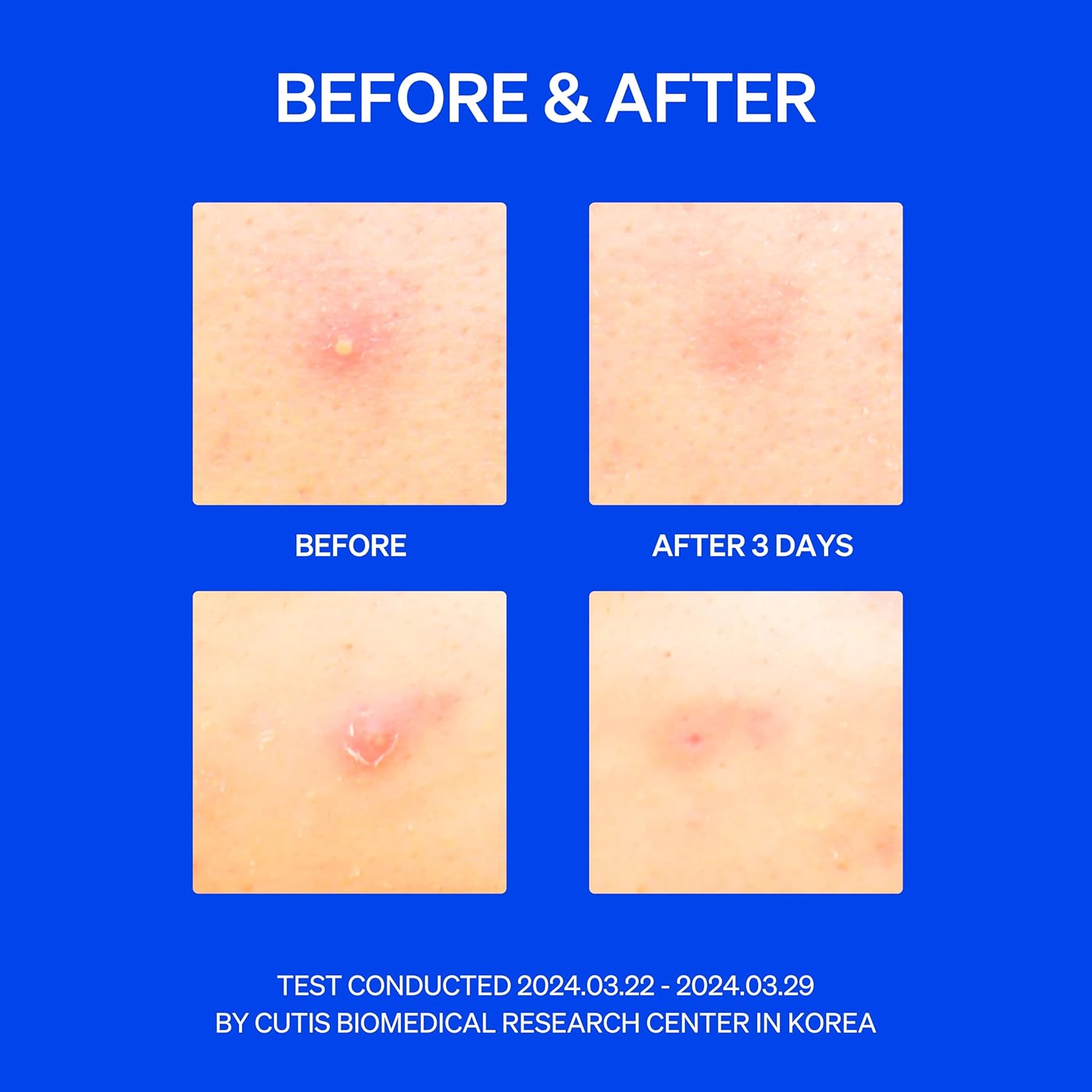 Before & After acne test results. Four skin close-ups show visible improvement in pimple condition: ‘Before’ and ‘After 3 Days.’ Bottom text: ‘Test conducted 2024.03.22 – 2024.03.29 by Cutis Biomedical Research Center in Korea.’ Blue background emphasizes clinical nature of the study.