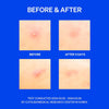 Before & After acne test results. Four skin close-ups show visible improvement in pimple condition: ‘Before’ and ‘After 3 Days.’ Bottom text: ‘Test conducted 2024.03.22 – 2024.03.29 by Cutis Biomedical Research Center in Korea.’ Blue background emphasizes clinical nature of the study.