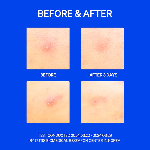 Before & After acne test results. Four skin close-ups show visible improvement in pimple condition: ‘Before’ and ‘After 3 Days.’ Bottom text: ‘Test conducted 2024.03.22 – 2024.03.29 by Cutis Biomedical Research Center in Korea.’ Blue background emphasizes clinical nature of the study.